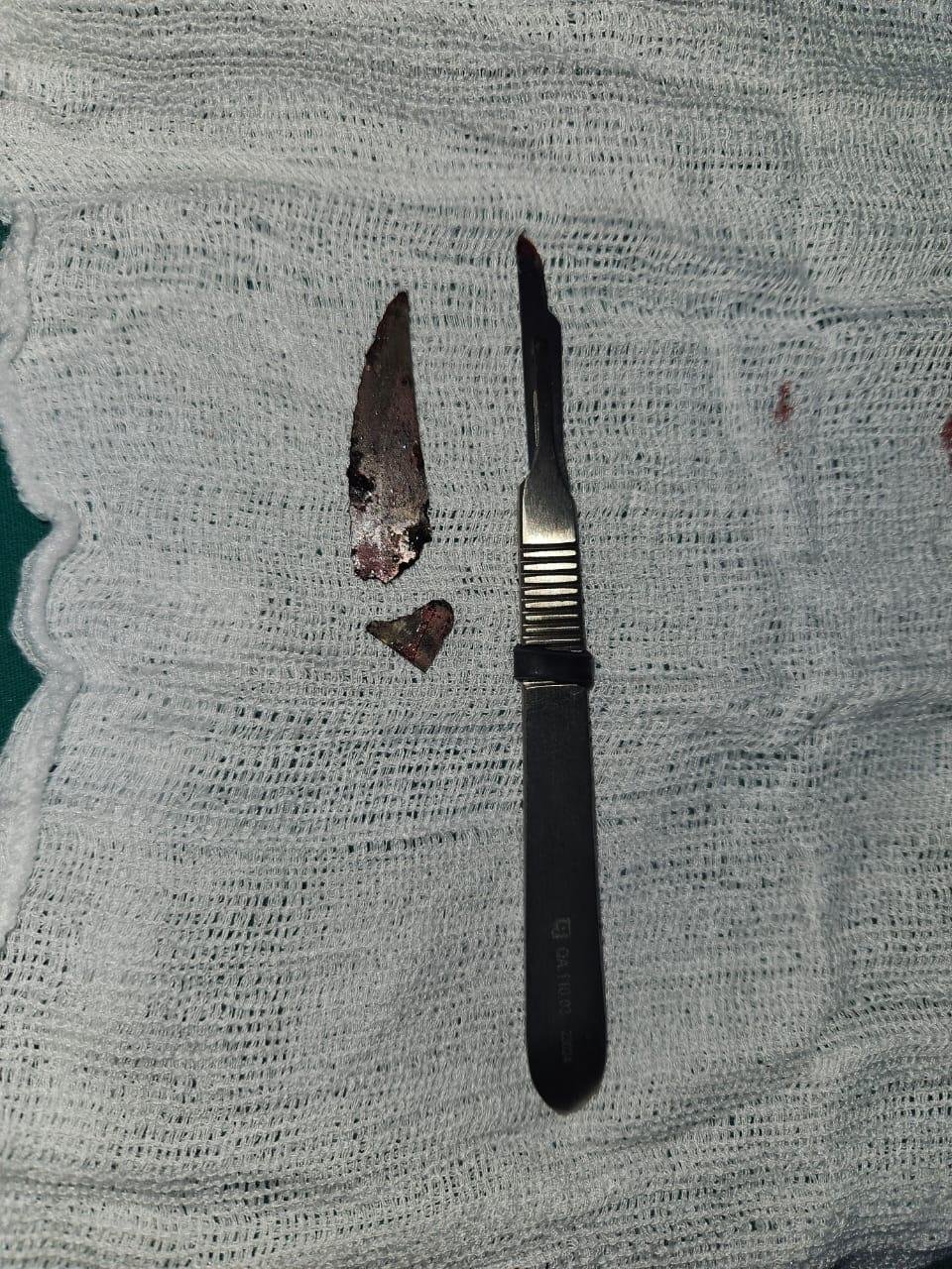 CIRURGIA BUCOMAXILO DO HRCC REMOVE LÂMINA ALOJADA EM ROSTO DE PACIENTE E DEVOLVE QUALIDADE DE VIDA APÓS UMA DÉCADA DE DORES