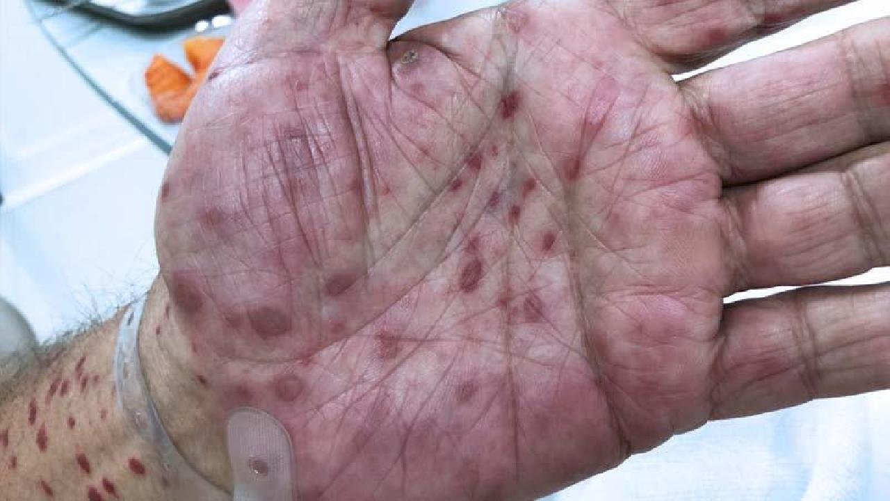 CASOS DE SÍFILIS AUMENTAM EM MAIS DE 135% NA BAHIA CASOS DE SÍFILIS AUMENTAM EM MAIS DE 135% NA BAHIA