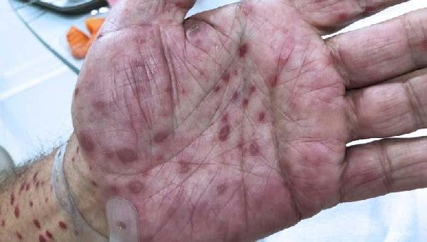 CASOS DE SÍFILIS AUMENTAM EM MAIS DE 135% NA BAHIA