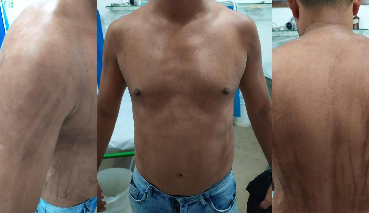 “QUEIMADURAS NA PELE DO HOMEM PODE NÃO TER RELAÇÃO COM ÓLEO, ELE PASSA BEM” AFIRMA SECRETÁRIO DE SAÚDE “QUEIMADURAS NA PELE DO HOMEM PODE NÃO TER RELAÇÃO COM ÓLEO, ELE PASSA BEM” AFIRMA SECRETÁRIO DE SAÚDE