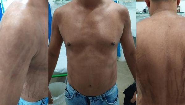 “QUEIMADURAS NA PELE DO HOMEM PODE NÃO TER RELAÇÃO COM ÓLEO, ELE PASSA BEM” AFIRMA SECRETÁRIO DE SAÚDE