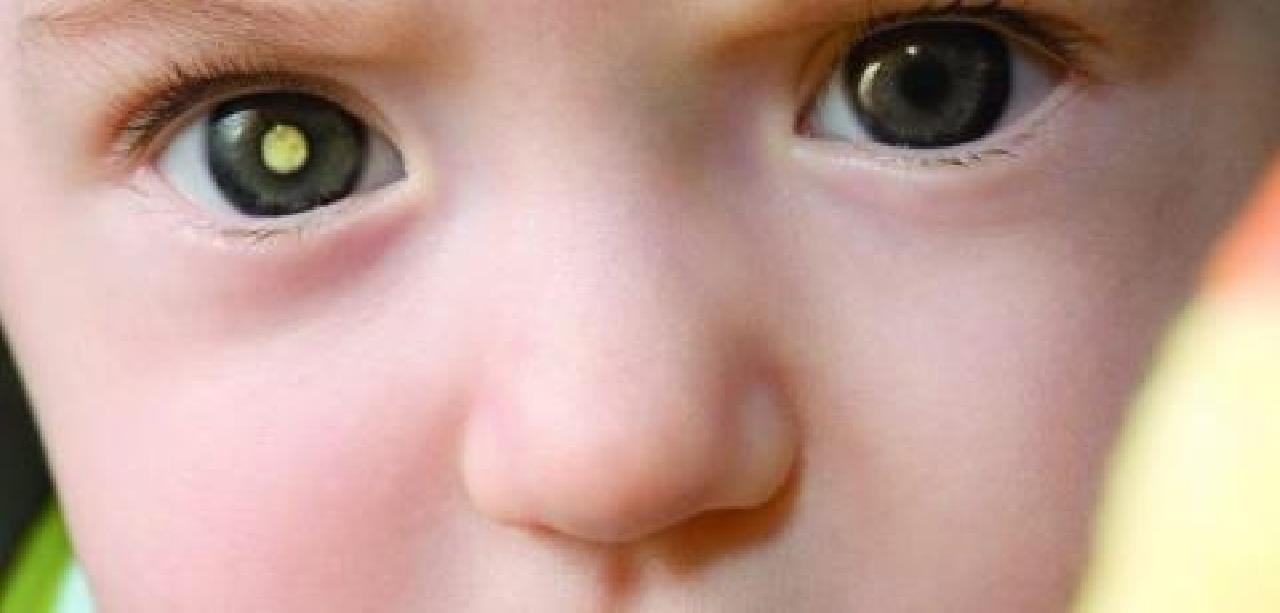 IDA REGULAR AO OFTALMOLOGISTA PODE PREVENIR CÂNCER NOS OLHOS IDA REGULAR AO OFTALMOLOGISTA PODE PREVENIR CÂNCER NOS OLHOS
