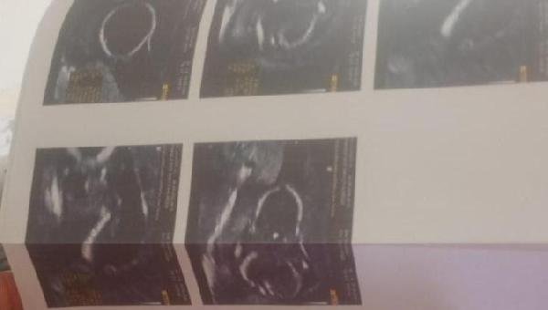 APÓS DENÚNCIA NO PROGRAMA O TABULEIRO DE DEMORA NA TRANSFERÊNCIA, SECRETÁRIA DE SAÚDE DE UNA INFORMA QUE GESTANTE COM ÓBITO FETAL JÁ FOI LEVADA AO HOSPITAL MATERNO EM ILHÉUS