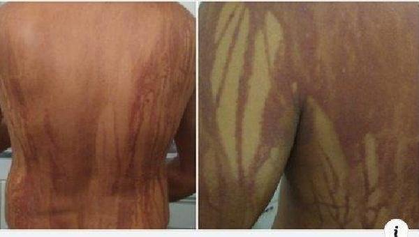 ILHÉUS: “PROVAVELMENTE FOI ÁGUA VIVA”, AFIRMA SECRETÁRIO SOBRE QUEIMADURAS EM TURISTA