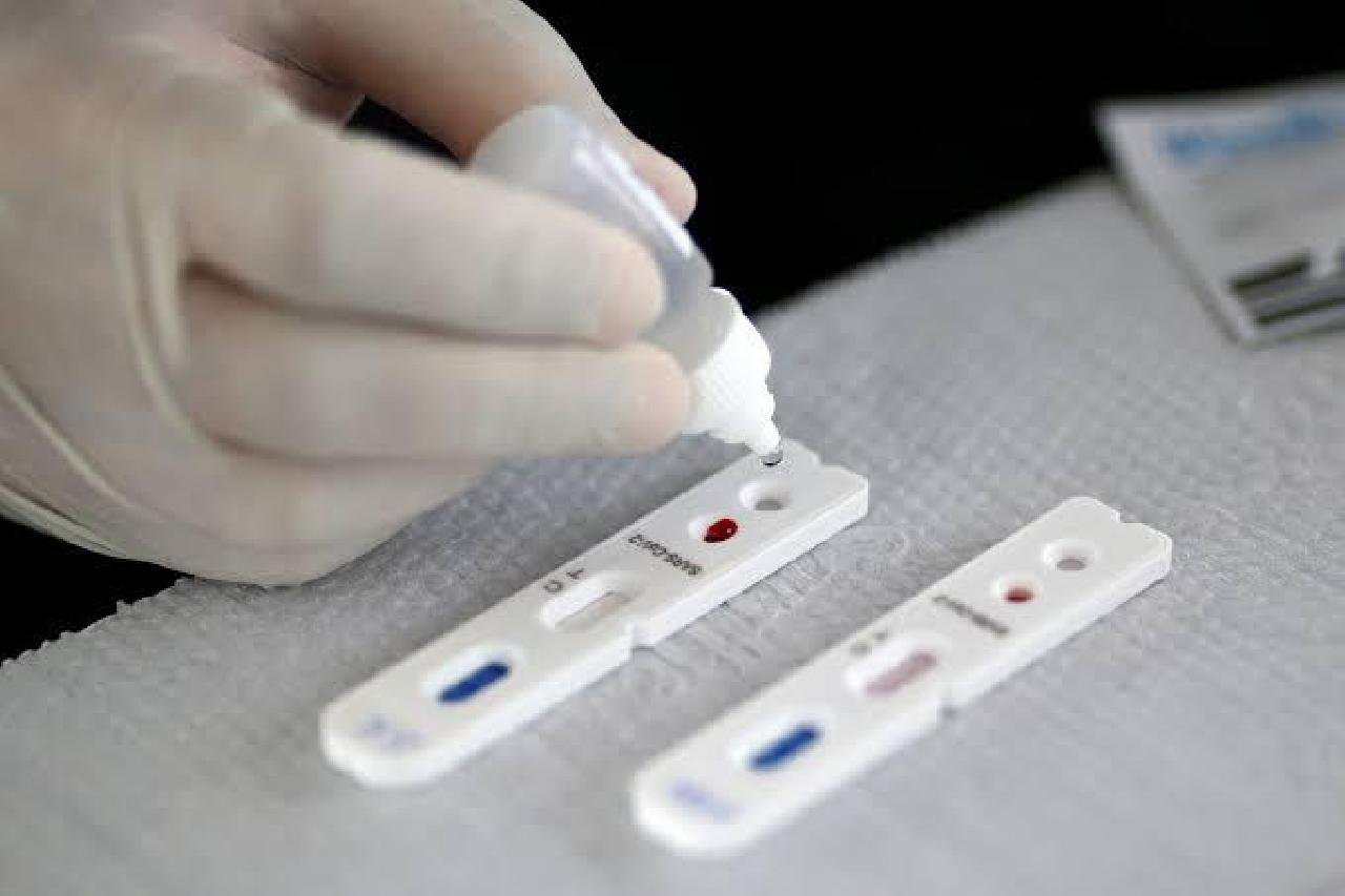 TESTE RÁPIDO POSITIVO PASSA A SER ACEITO PARA NOTIFICAR CASOS DE PACIENTES COM COVID-19 TESTE RÁPIDO POSITIVO PASSA A SER ACEITO PARA NOTIFICAR CASOS DE PACIENTES COM COVID-19