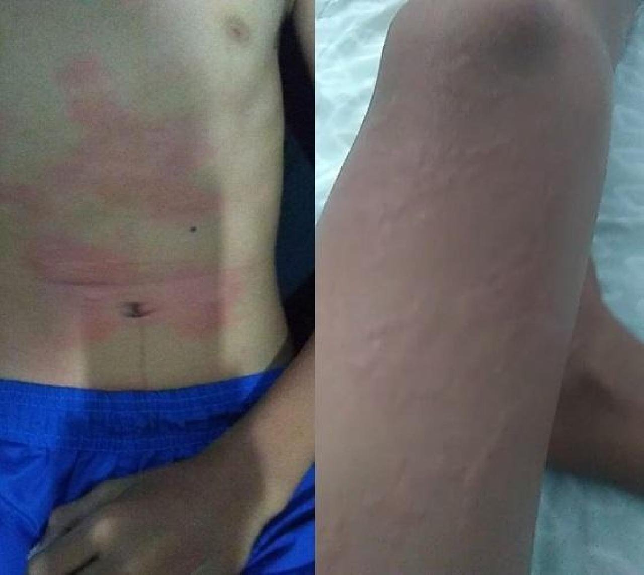 ILHÉUS: MENINO DE 11 ANOS SOFRE REAÇÃO ALÉRGICA APÓS TOMAR BANHO DE MAR NA ZONA SUL ILHÉUS: MENINO DE 11 ANOS SOFRE REAÇÃO ALÉRGICA APÓS TOMAR BANHO DE MAR NA ZONA SUL